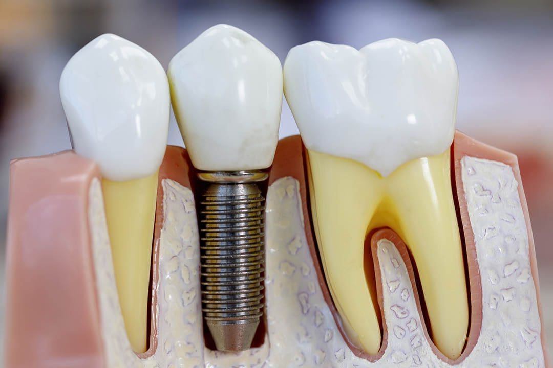 are dental implants permanent