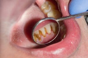 teeth plaque
